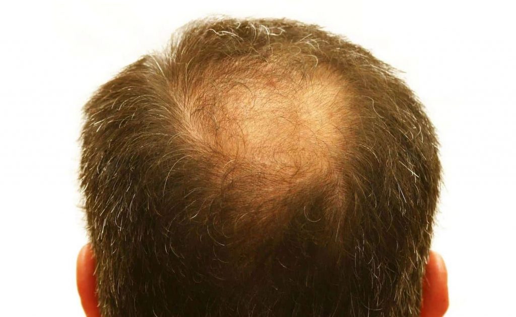 تاثیر شامپو ضد ریزش مو
